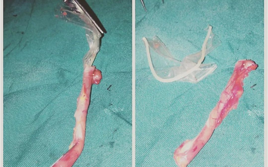 Condón inhalado y encontrado en el pulmón: Un caso médico insólito