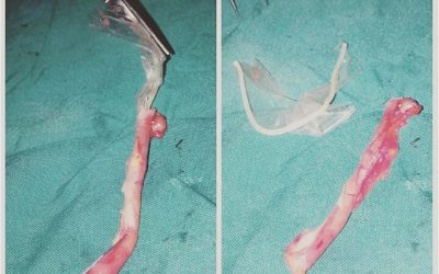 Condón inhalado y encontrado en el pulmón: Un caso médico insólito